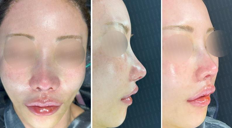 Photos taken immediately after surgery, frontal view, 45-angle view, and side profile.