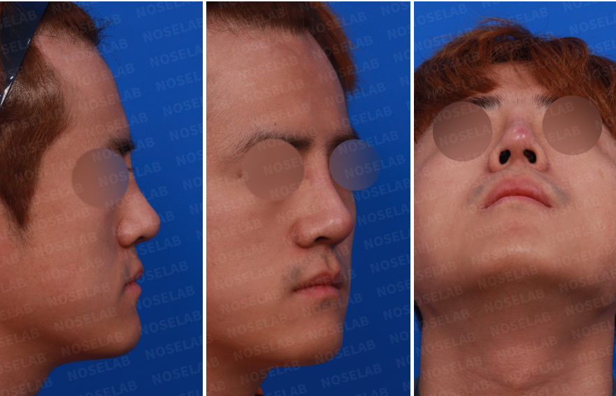 preoperative right side, oblique, and nostril views of silicone exposure rhinoplasty case showing nasal inflammation, redness, and implant-related deformity before closed rhinoplasty Korea