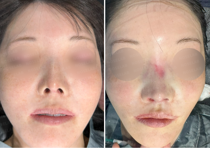 Frontal view comparison before (left) and after (right) contracted nose revision rhinoplasty, showing improvement in nasal length, symmetry, and tip position.