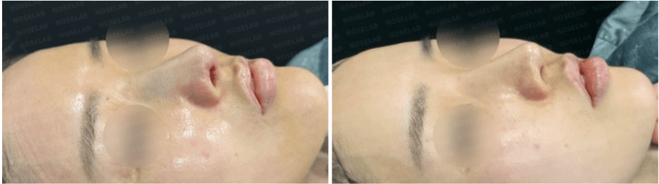 Photos were taken immediately before and after the surgery with the consent of the patient.