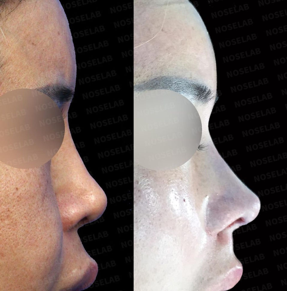 Right 90-degree side view before and after Crooked Nose Correction – Closed Rhinoplasty Korea