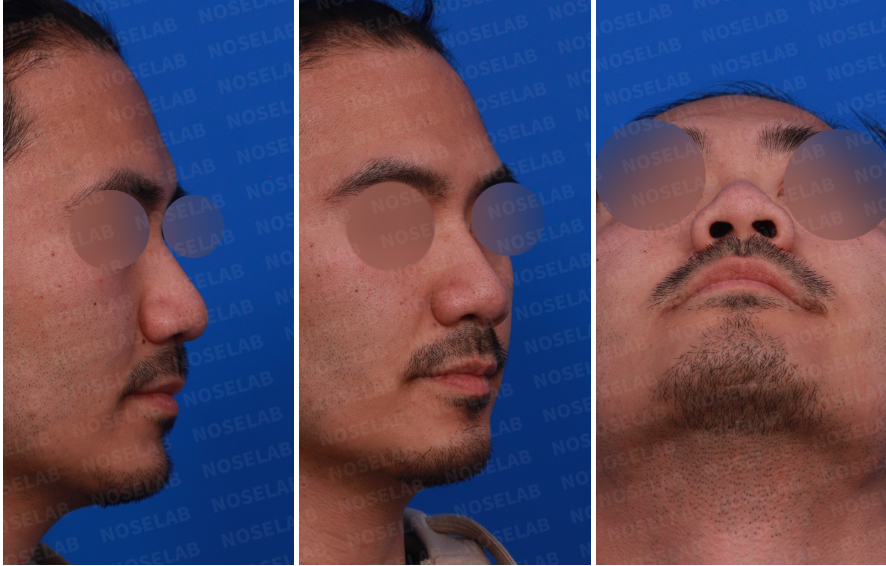 Preoperative consultation photos of a male patient – right side, oblique side, and nostril view. Assessment of nostril asymmetry and low nasal bridge start prior to closed rhinoplasty.