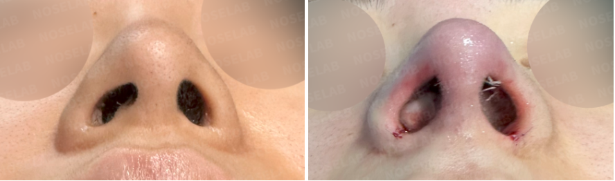 Nostril base view before and after rhinoplasty, demonstrating improved symmetry and refined nasal tip