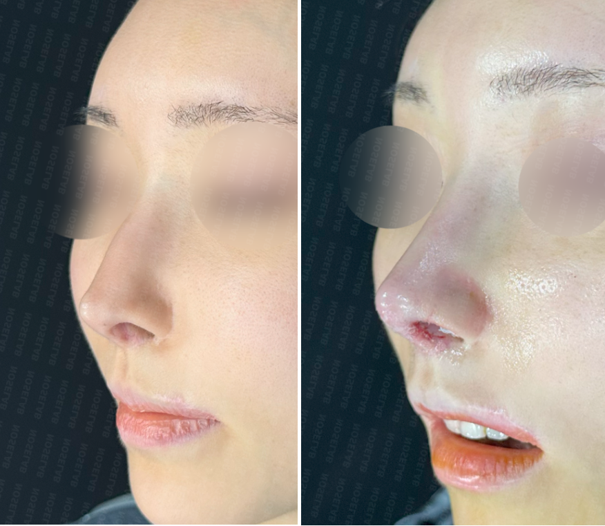Before (left) and immediately after (right) customized rhinoplasty for cartilage visibility – oblique view showing softened pointed tip, corrected cartilage show-through, and improved nasal balance
