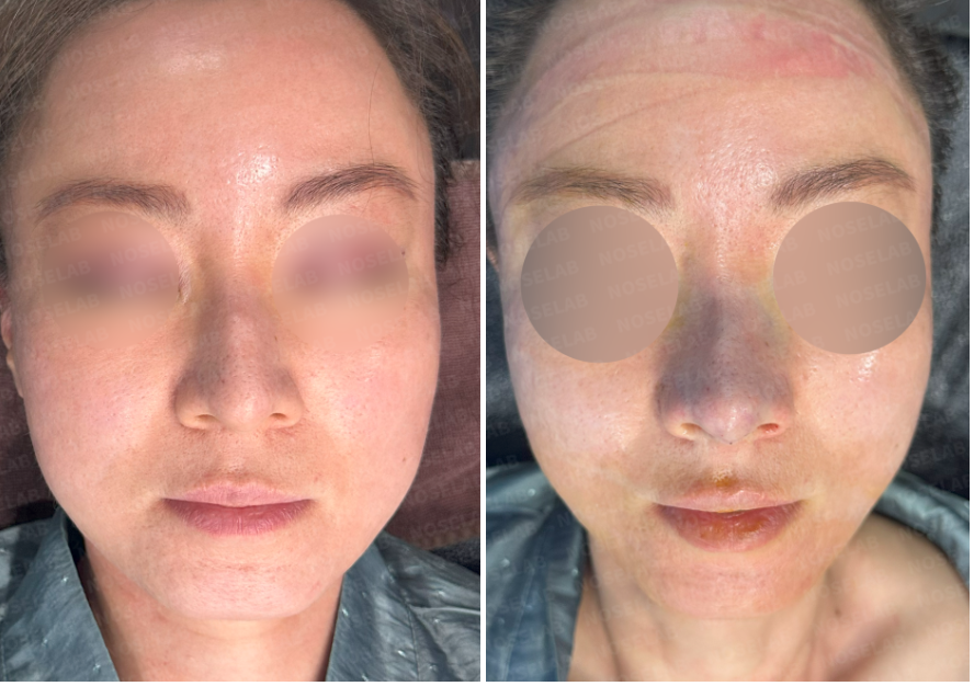 Frontal view before and immediately after droopy nose and hump correction rhinoplasty – showing refined tip and improved nostril symmetry.