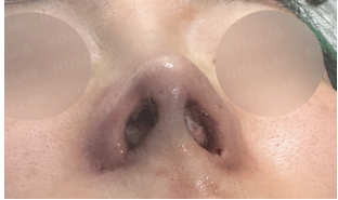 Immediately after surgery: nostril view showing improved symmetry and natural contour – Nose Lab Clinic