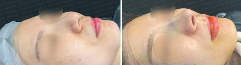 45-degree angle before surgery (left), After surgery (right)