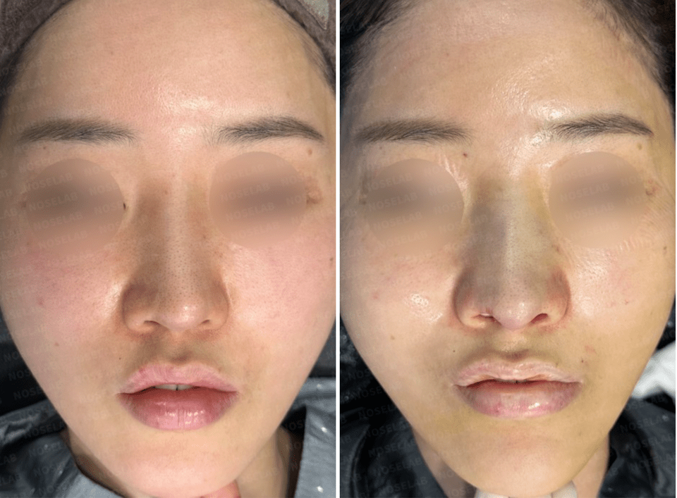 Photos were taken immediately before and after the surgery with the consent of the patient.