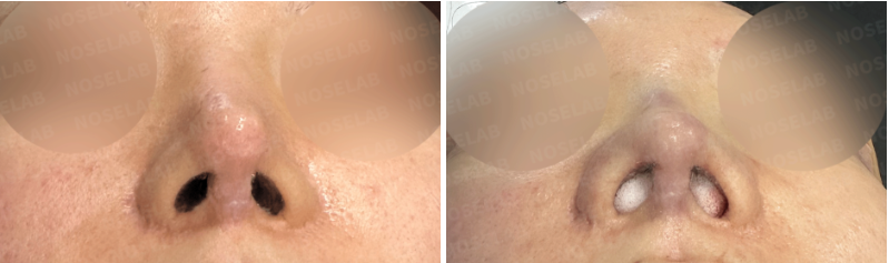 Before surgery (left) and immediately after autologous rib cartilage reconstruction (right) – nostril/base view comparison of female patient