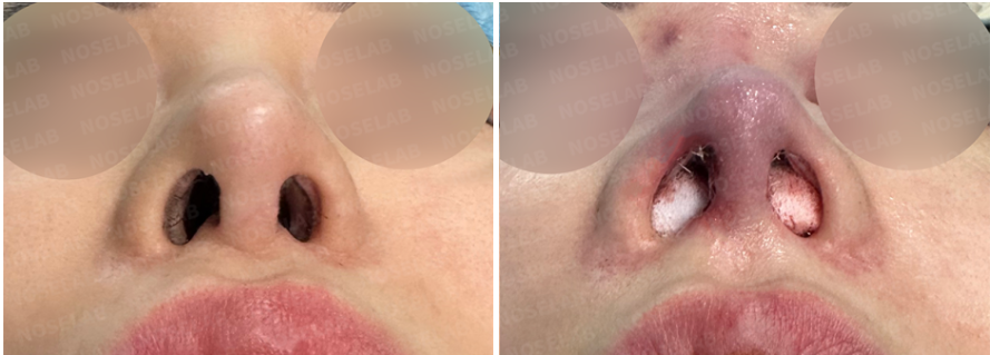 Nostril view before and after long nose correction, showing correction of asymmetry and reduced flaring.