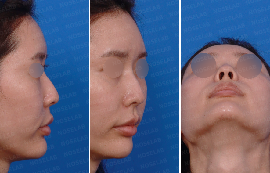 Preoperative views before autologous rib cartilage rhinoplasty showing right side and nostril views