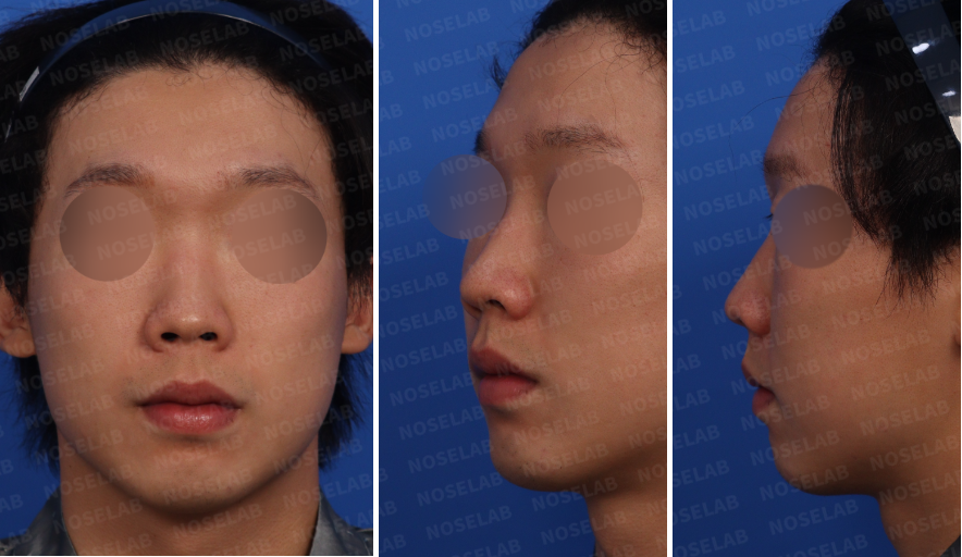 Pre-surgery consultation photos for upturned nose, small nose, and nasolabial angle correction – frontal, left oblique, and left profile views.