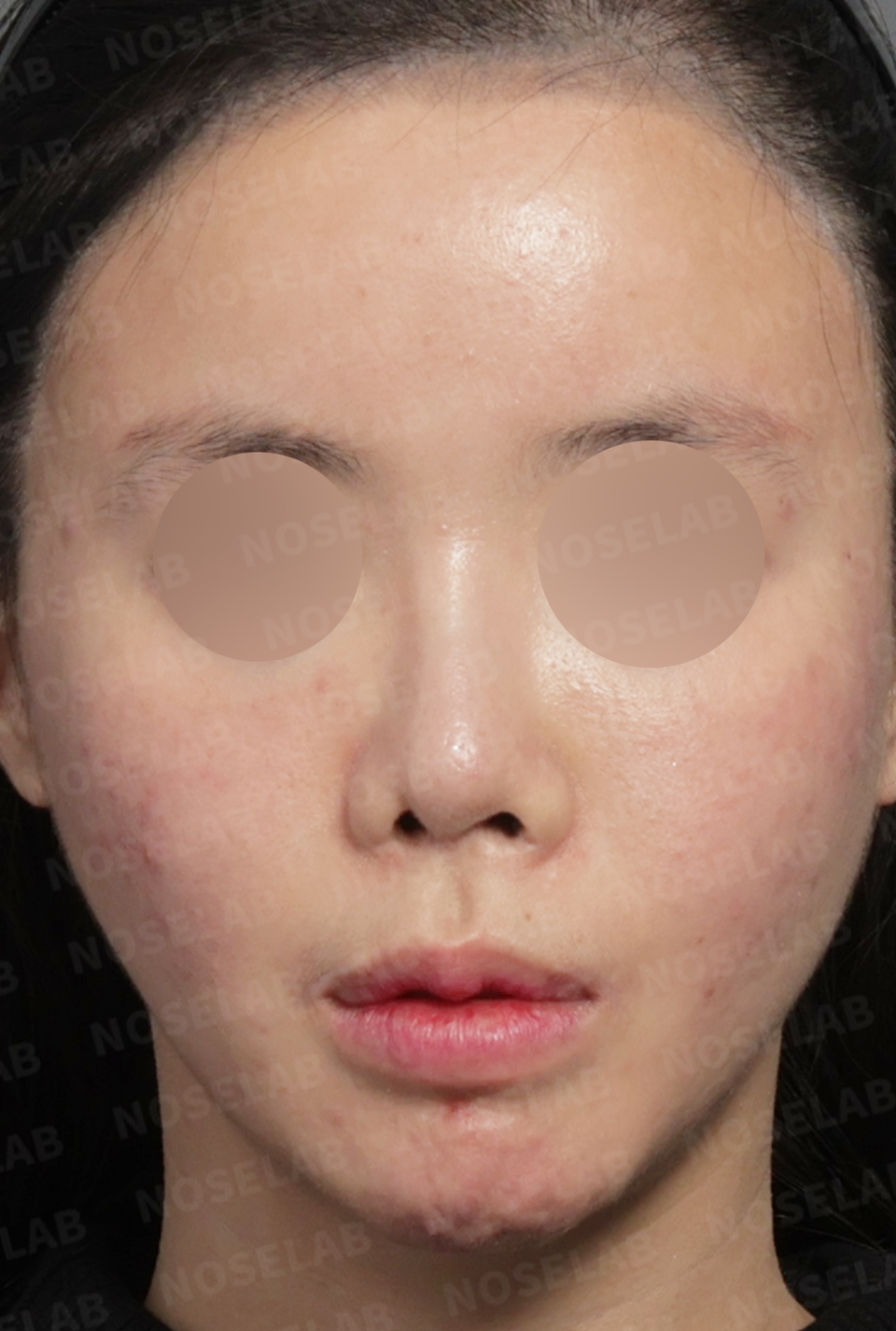 Preoperative consultation: frontal view.