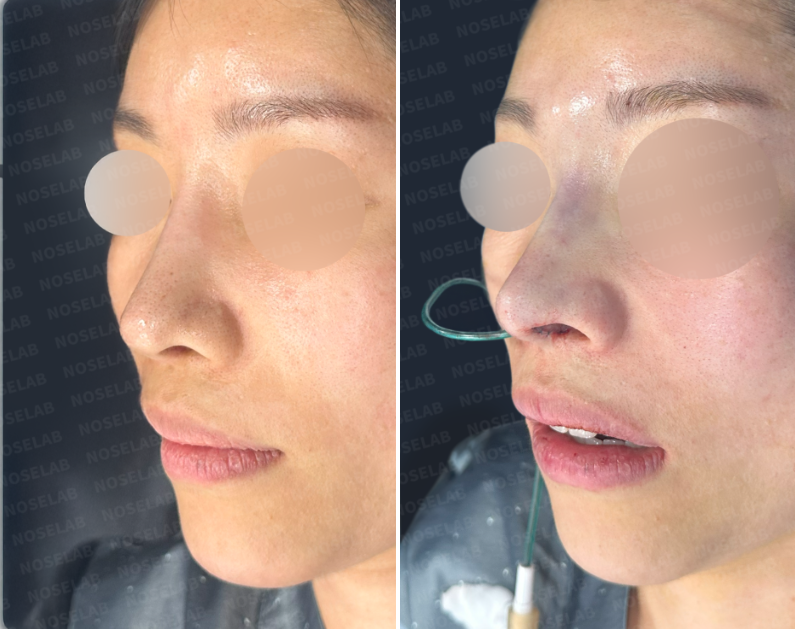 Comparison of before and immediately after closed short nose revision in Korea: Oblique side view.
