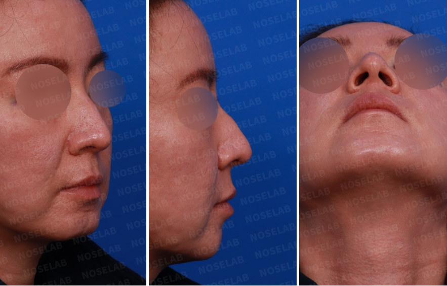 esign consultation – right oblique, side, and nostril views before droopy nose and hump correction rhinoplasty