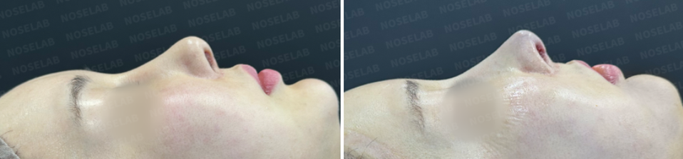 Before surgery (left), after surgery (right) From the side view, we can observe that the starting point of the nose bridge was lowered, and the bumpy parts of the nasal dorsum were improved.
