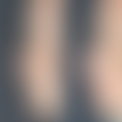 Before and after profile view of upturned nose correction surgery, showing improved nasal tip projection and smoother bridge.