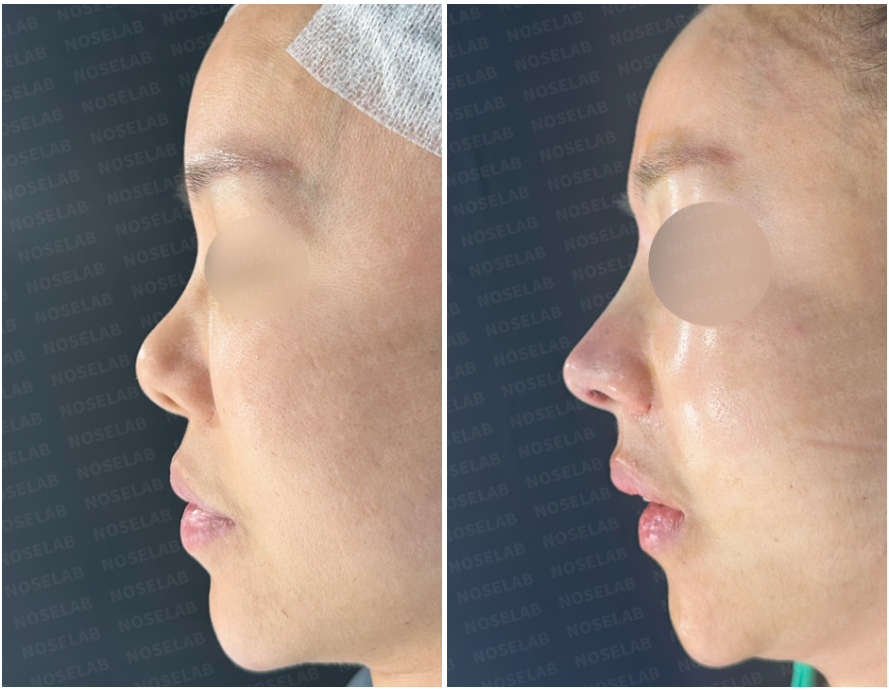 Side profile comparison before and immediately after secondary rhinoplasty, showing enhanced nasal bridge and refined nasal tip after silicone removal.