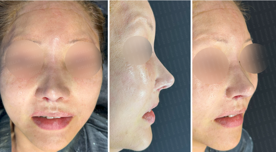 Photos taken immediately after surgery: frontal view, side profile, and 45-degree angle view.
