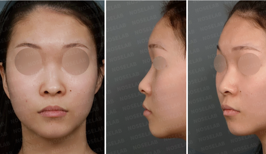 Preoperative consultation photos showing frontal view, left oblique view, and left side profile of a patient with a low nasal bridge and wide nasal tip before closed rhinoplasty.