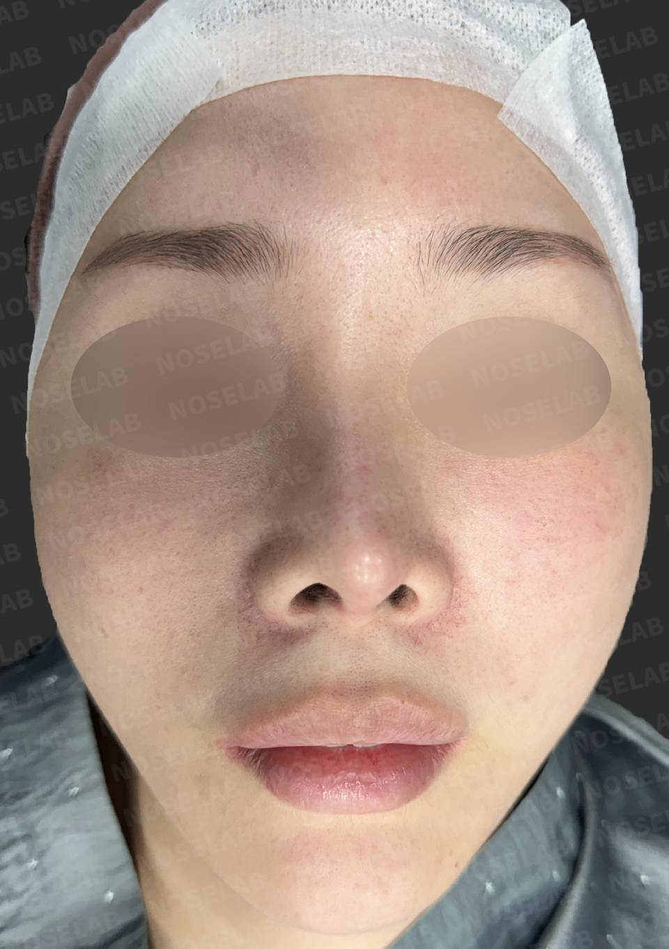 Before surgery: frontal view.