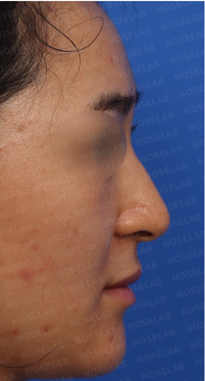 Nose hump correction Korea – preoperative side profile view of hooked nose with nasal hump and droopy tip