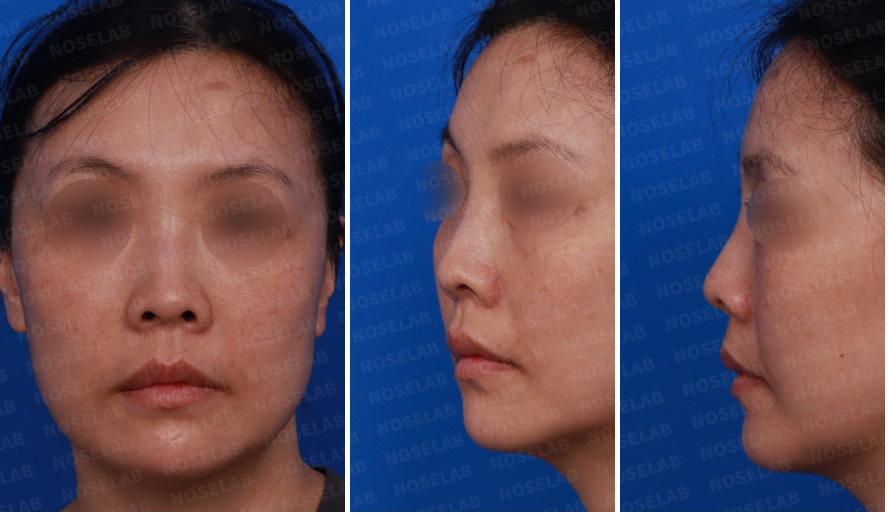 Preoperative consultation photos for primary rhinoplasty – frontal, left oblique, and side views showing baseline nasal shape.