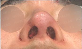 Immediately after deviated septum and wide nose correction – nostril view showing improved septal alignment and nostril symmetry