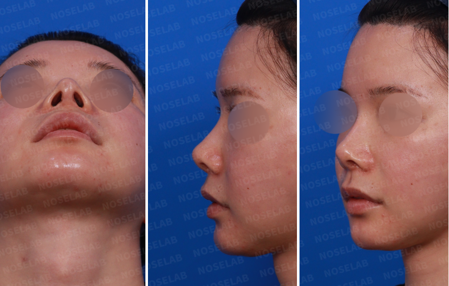 Pre-surgery design consultation – combined nostril, side, and oblique side views before Revision Rhinoplasty Korea with closed approach, showing nostril asymmetry, depressed nasal tip skin, and deviated nasal bridge.