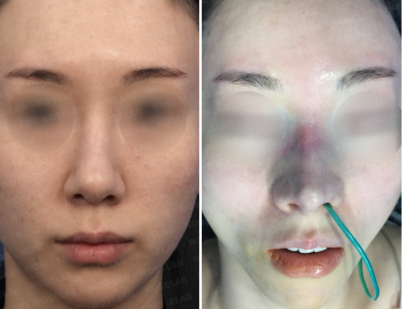 Frontal view before surgery (left), After surgery (right)