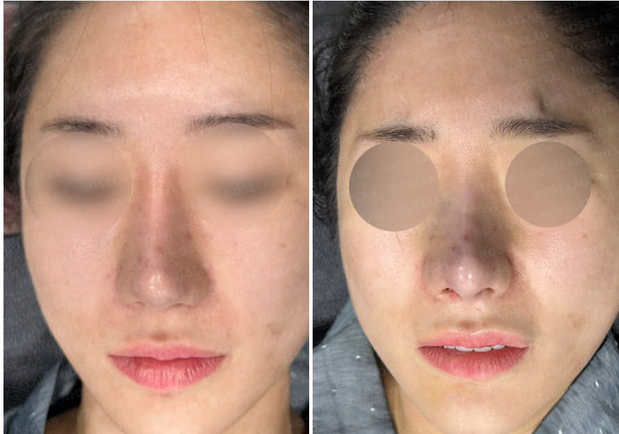 Before and immediately after revision rhinoplasty for correcting overly reduced alar base – frontal view.