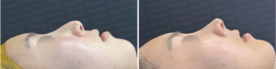 90-degree side profile before-and-after photos showing improvement of droopy nasal tip and lifted columella.