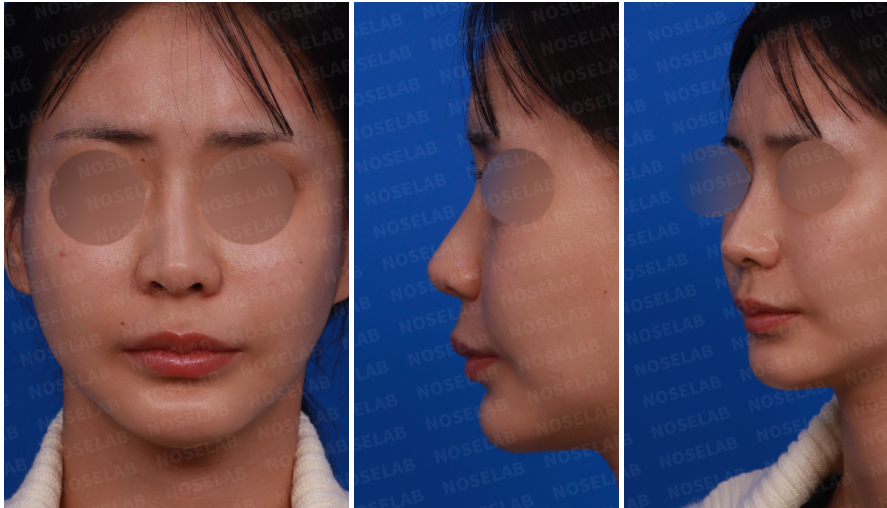 Post-Orthognathic Septal Reconstruction design consultation – frontal, left side, and oblique views showing nasal asymmetry and septal deviation before closed rhinoplasty revision.
