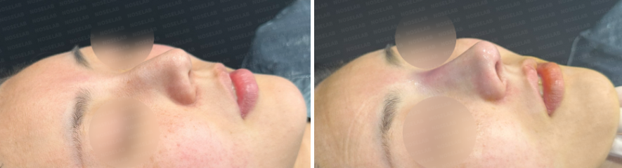 45-degree angle view before surgery (left) after surgery (right)