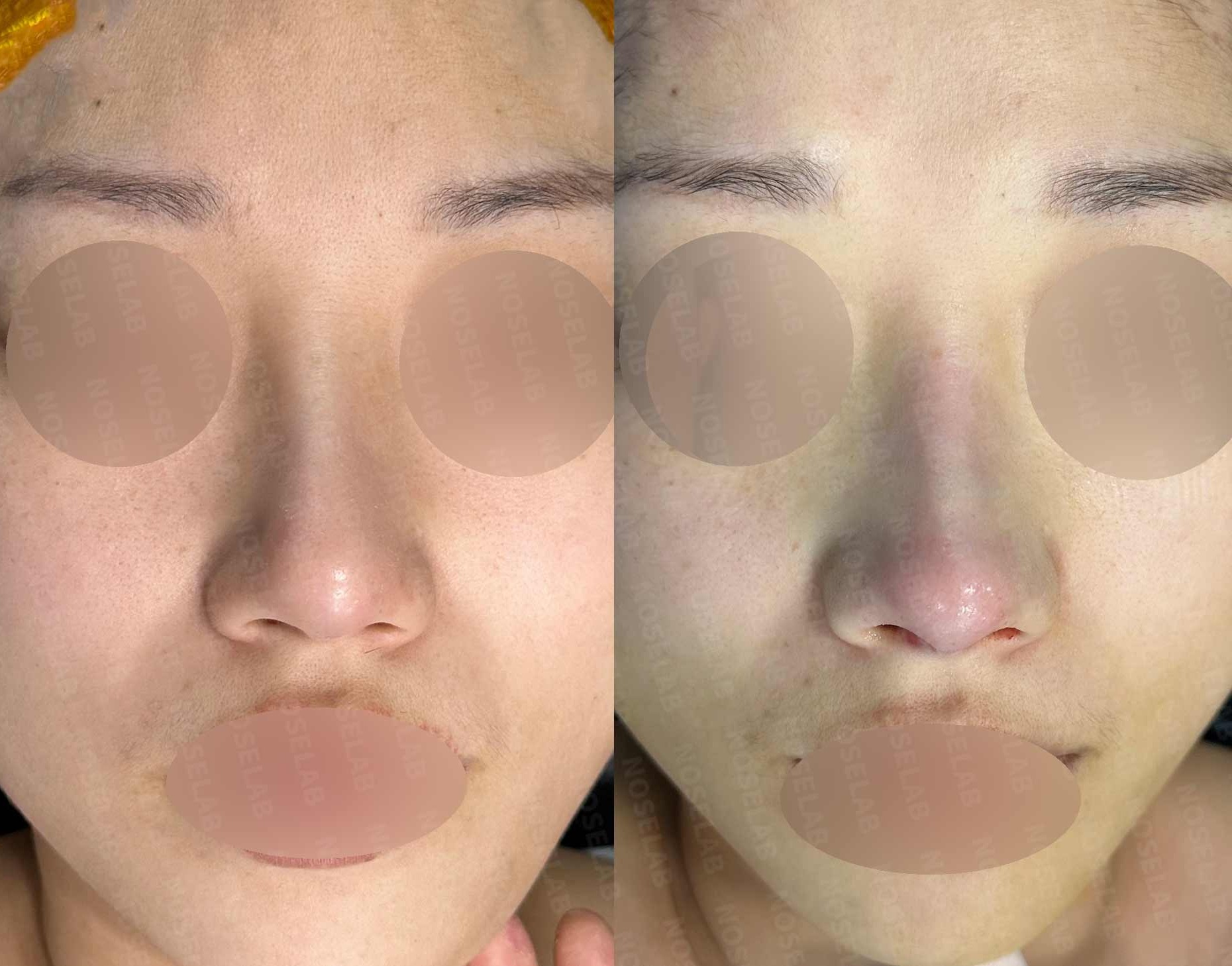 Patient consultation photo showing frontal nasal assessment for alignment correction surgery