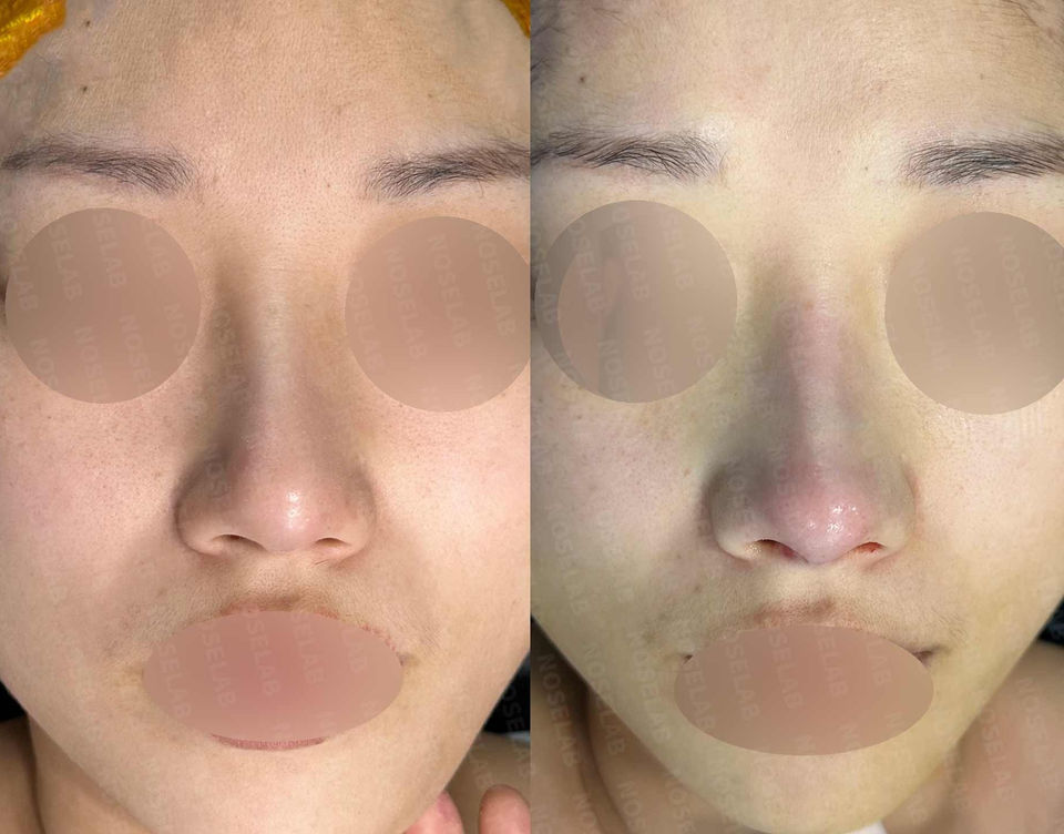 Frontal view before and after Deviated and Droopy Nose Correction – Closed Rhinoplasty Korea