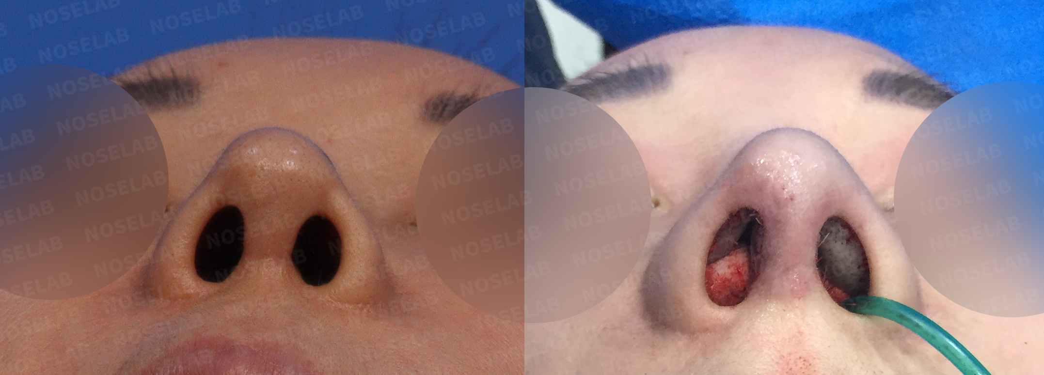 Nostril base view comparison demonstrating improved alar symmetry and columellar positioning following revision rhinoplasty