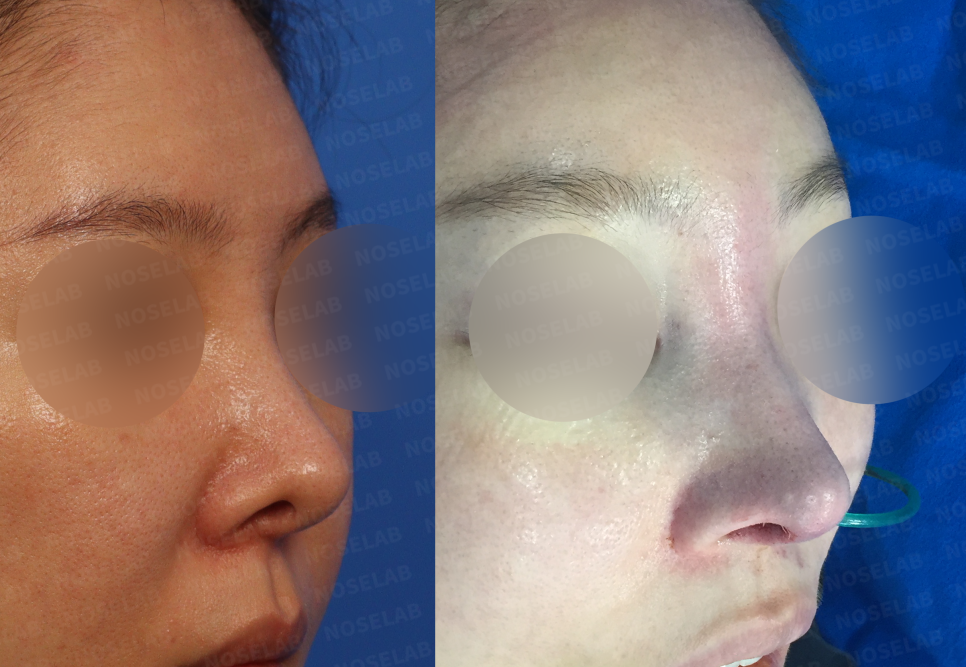 Three-quarter angle view showing improved nasal contour and symmetry achieved through revision surgery in Seoul, South Korea