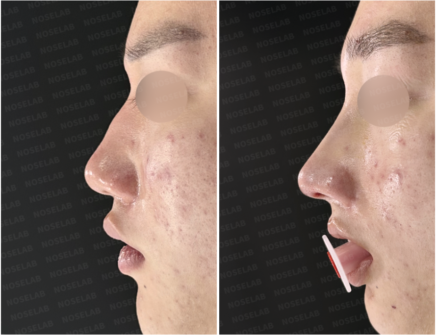 Before and immediately after surgery lateral view showing straightened nasal bridge, smoothing of the dorsal hump, improved tip projection, and a more balanced masculine nasal profile following closed rhinoplasty with osteotomy and rib cartilage reconstruction.