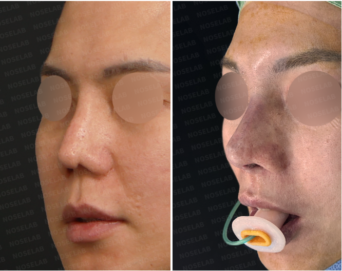 Oblique before and immediately after views showing rib cartilage revision rhinoplasty Korea with improved nasal contour and contracted nose reconstruction.