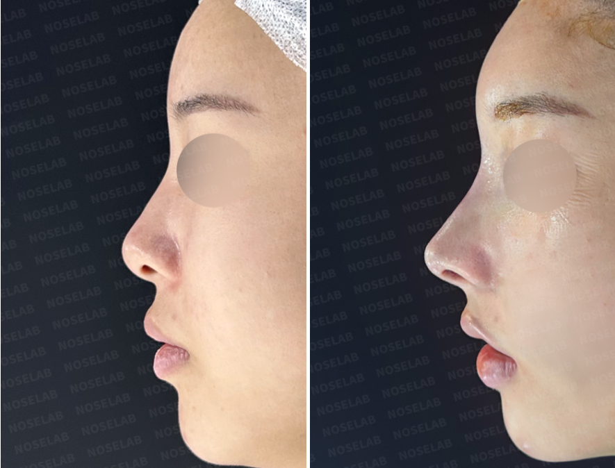 Before and immediately after surgery left lateral view comparison showing a straighter nasal bridge and improved nasal tip projection following primary rhinoplasty.