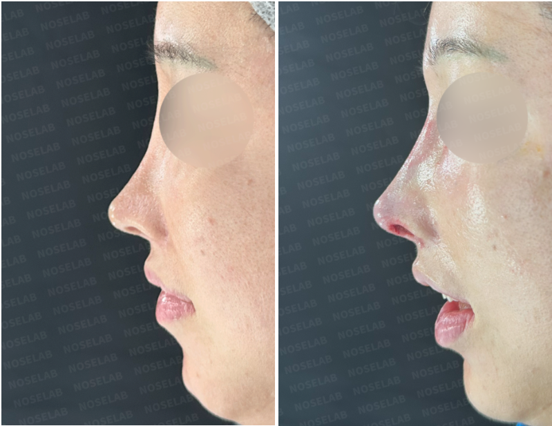 Before and immediately after closed rhinoplasty: side view comparison.