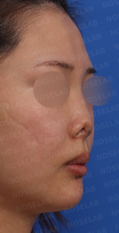 Preoperative 45-degree view showing deviation and upturned nasal tip before severe nasal contracture correction