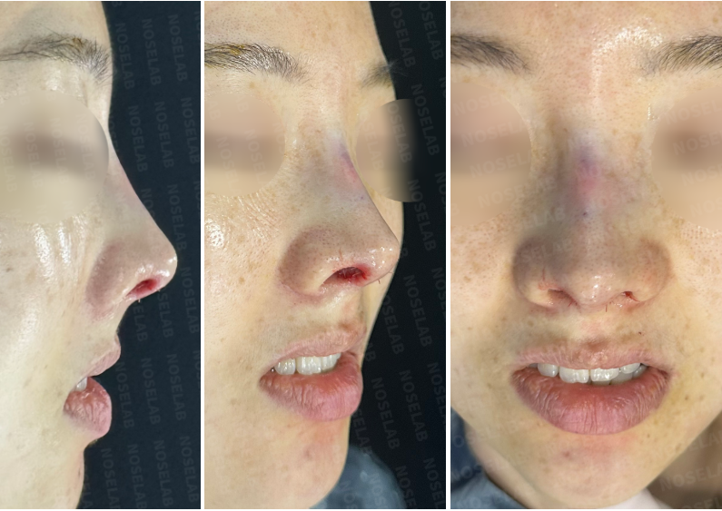 Immediate postoperative composite photo showing 45-degree, frontal, and nostril views. The images highlight the corrected nasal bridge, elevated nasal tip, improved columella shape, and reduced nostril asymmetry.