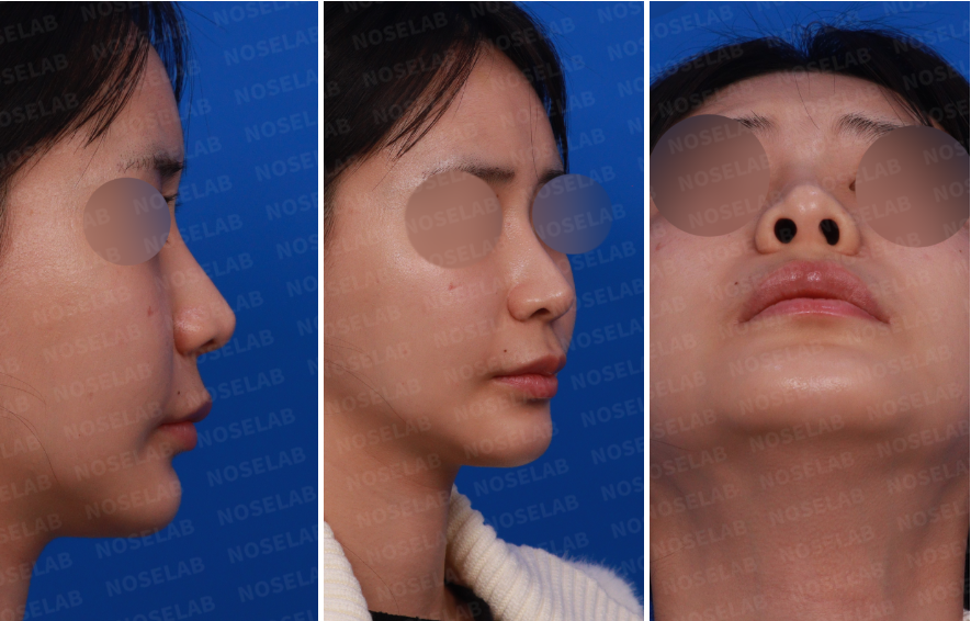 Post-Orthognathic Septal Reconstruction design consultation – right side, oblique side, and nostril view photos showing nasal base asymmetry and septal deviation before closed rhinoplasty revision.