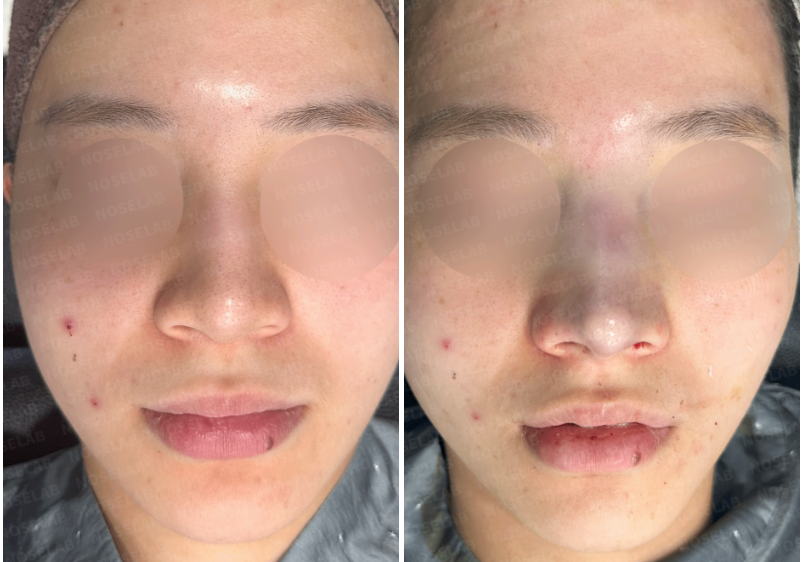 Before and after rhinoplasty – frontal view showing improvement in nasal definition and tip symmetry.