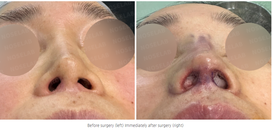 Nostril view before and after philtrum reduction correction with correction of severe asymmetry