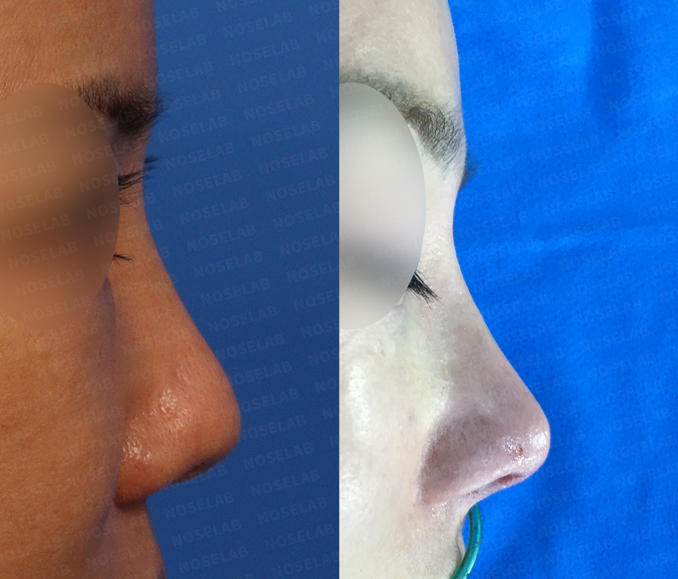 Closed Rhinoplasty Korea Mild Contracted Blunt Nose before and after side view – improved nasal bridge line, lifted nasal tip, and reduced droopy columella using self rib cartilage by Dr. Cha-Young Kang, NoseLab Clinic