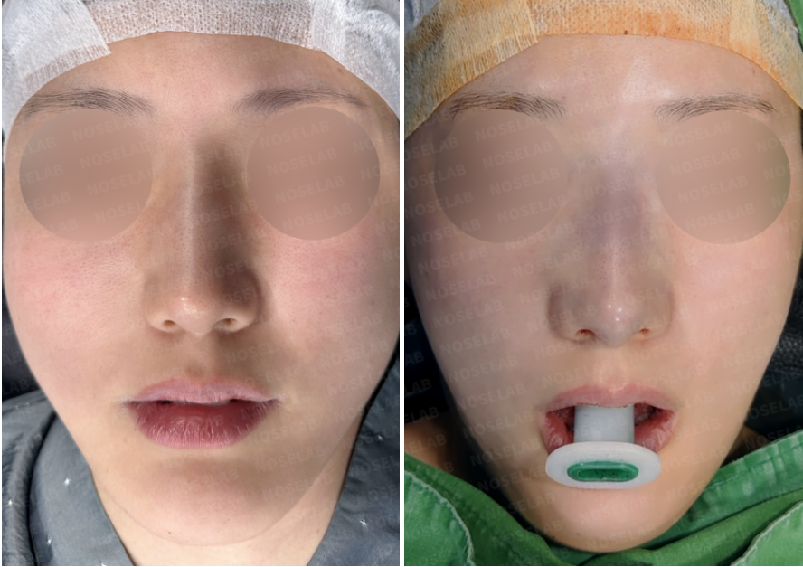 Before and immediately after surgery frontal view showing correction of crooked nasal bones and dorsal hump following revision closed rhinoplasty with lateral osteotomy and autologous rib cartilage.