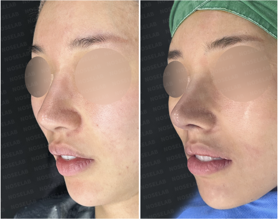 Visible Cartilage Revision Rhinoplasty Korea before and after oblique view with dermis graft